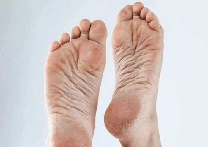 7 Cara Mencegah Kapalan dan Kaki Lecet